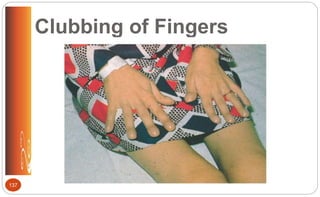 Clubbing of Fingers
137
 