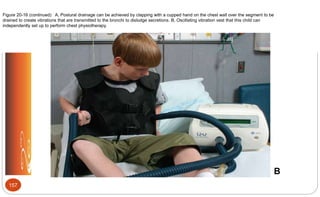 Figure 20-16 (continued) A, Postural drainage can be achieved by clapping with a cupped hand on the chest wall over the segment to be
drained to create vibrations that are transmitted to the bronchi to dislodge secretions. B, Oscillating vibration vest that this child can
independently set up to perform chest physiotherapy.
B
157
 