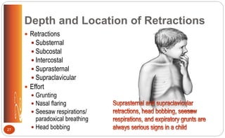 Depth and Location of Retractions
 Retractions
 Substernal
 Subcostal
 Intercostal
 Suprasternal
 Supraclavicular
 Effort
 Grunting
 Nasal flaring
 Seesaw respirations/
paradoxical breathing
 Head bobbing27
 