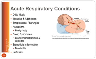 Acute Respiratory Conditions
 Otitis Media
 Tonsillitis & Adenoiditis
 Streptococcal Pharyngitis
 Aspirations
 Foreign body
 Croup Syndromes
 Laryngotracheobronchitis &
epiglottitis
 Bronchiole Inflammation
 Bronchiolitis
 Pertussis
36
 