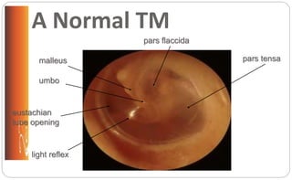 A Normal TM
pars flaccida
umbo
malleus
light reflex
pars tensa
eustachian
tube opening
 