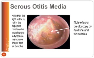 Serous Otitis Media
Note effusion
on otoscopy by
fluid line and
air bubbles
Note that the
light reflex is
not in the
expected
position due
to a change
in tympanic
membrane
shape from
air bubbles
45
 
