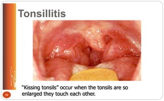 Tonsillitis
“Kissing tonsils” occur when the tonsils are so
enlarged they touch each other.58
 