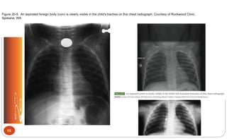 Figure 20-5 An aspirated foreign body (coin) is clearly visible in the child’s trachea on this chest radiograph. Courtesy of Rockwood Clinic,
Spokane, WA.
66
 