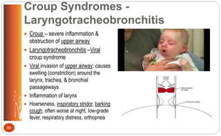 Croup Syndromes -
Laryngotracheobronchitis
 Croup – severe inflammation &
obstruction of upper airway
 Laryngotracheobronchitis –Viral
croup syndrome
 Viral invasion of upper airway: causes
swelling (constriction) around the
larynx, trachea, & bronchial
passageways
 Inflammation of larynx
 Hoarseness, inspiratory stridor, barking
cough, often worse at night, low-grade
fever, respiratory distress, orthopnea
68
 