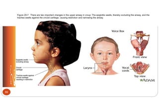 Figure 20-7 There are two important changes in the upper airway in croup: The epiglottis swells, thereby occluding the airway, and the
trachea swells against the cricoid cartilage, causing restriction and narrowing the airway.
69
 