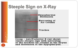 Steeple Sign on X-Ray
70
 