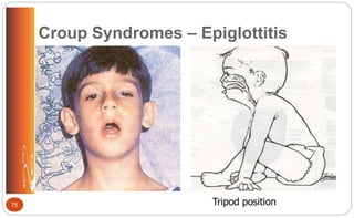 Croup Syndromes – Epiglottitis
Tripod position75
 
