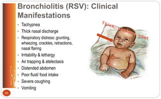 Bronchiolitis (RSV): Clinical
Manifestations
• Tachypnea
• Thick nasal discharge
• Respiratory distress: grunting,
wheezing, crackles, retractions,
nasal flaring
• Irritability & lethargy
• Air trapping & atelectasis
• Distended abdomen
• Poor fluid/ food intake
• Severe coughing
• Vomiting
83
 