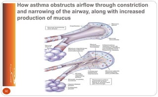 How asthma obstructs airflow through constriction
and narrowing of the airway, along with increased
production of mucus
92
 