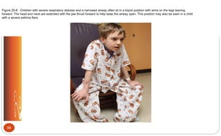 Figure 20-8 Children with severe respiratory distress and a narrowed airway often sit in a tripod position with arms on the legs leaning
forward. The head and neck are extended with the jaw thrust forward to help keep the airway open. This position may also be seen in a child
with a severe asthma flare.
98
 