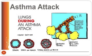 Asthma Attack
99
 