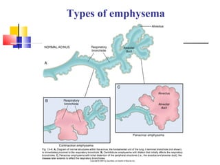 Types of emphysema
 