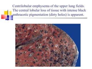 Centrilobular emphysema of the upper lung fields.
The central lobular loss of tissue with intense black
anthracotic pigmentation (dirty holes) is apparent.
 