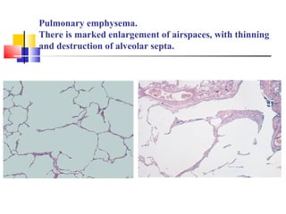 Pulmonary emphysema.
There is marked enlargement of airspaces, with thinning
and destruction of alveolar septa.
 