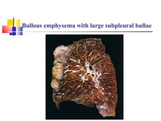 Bullous emphysema with large subpleural bullae
 