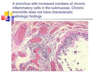 A bronchus with increased numbers of chronic
inflammatory cells in the submucosa. Chronic
bronchitis does not have characteristic
pathologic findings
 