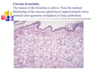 Chronic bronchitis.
The lumen of the bronchus is above. Note the marked
thickening of the mucous gland layer (approximately twice
normal) and squamous metaplasia of lung epithelium.
 