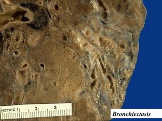 Bronchiectasis
 