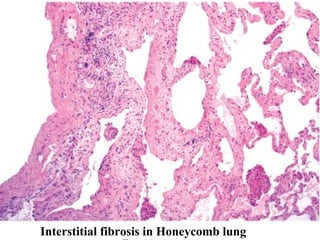Interstitial fibrosis in Honeycomb lung
 