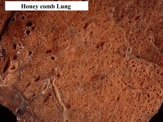 Honey comb Lung
 