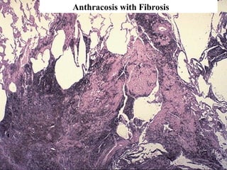 Anthracosis with Fibrosis
 