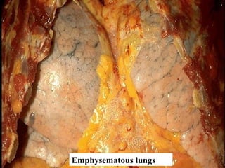 Emphysematous lungs
 