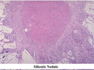 Silicotic Nodule
 