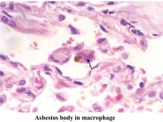 Asbestos body in macrophage
 