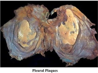 Pleural Plaques
 