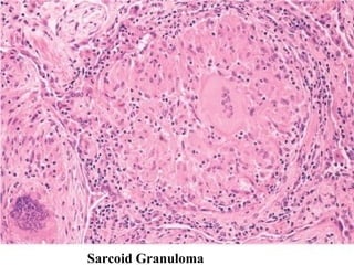Sarcoid Granuloma
 