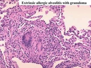 Extrinsic allergic alveolitis with granuloma
 