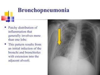 Bronchopneumonia
 Patchy distribution of
inflammation that
generally involves more
than one lobe.
 This pattern results from
an initial infection of the
bronchi and bronchioles
with extension into the
adjacent alveoli.
 