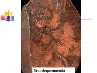 Bronchopneumonia
 