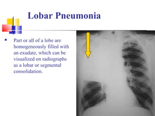 Lobar Pneumonia
 Part or all of a lobe are
homogeneously filled with
an exudate, which can be
visualized on radiographs
as a lobar or segmental
consolidation.
 