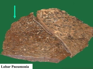 Lobar Pneumonia
 