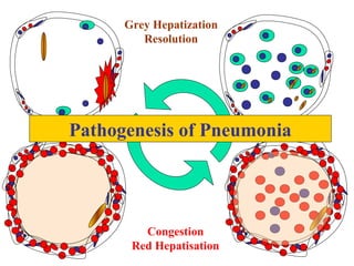 Congestion
Red Hepatisation
Grey Hepatization
Resolution
Pathogenesis of Pneumonia
 