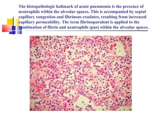 The histopathologic hallmark of acute pneumonia is the presence of
neutrophils within the alveolar spaces. This is accompanied by septal
capillary congestion and fibrinous exudates, resulting from increased
capillary permeability. The term fibrinopurulent is applied to the
combination of fibrin and neutrophils (pus) within the alveolar spaces.
 
