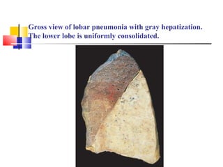 Gross view of lobar pneumonia with gray hepatization.
The lower lobe is uniformly consolidated.
 
