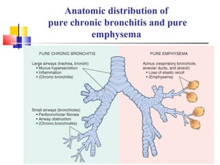 Anatomic distribution of
pure chronic bronchitis and pure
emphysema
 