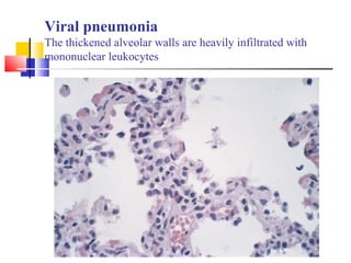 Viral pneumonia
The thickened alveolar walls are heavily infiltrated with
mononuclear leukocytes
 