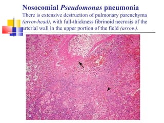 Nosocomial Pseudomonas pneumonia
There is extensive destruction of pulmonary parenchyma
(arrowhead), with full-thickness fibrinoid necrosis of the
arterial wall in the upper portion of the field (arrow).
 