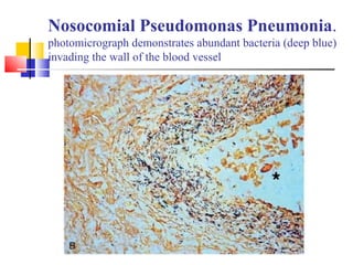 Nosocomial Pseudomonas Pneumonia.
photomicrograph demonstrates abundant bacteria (deep blue)
invading the wall of the blood vessel
 