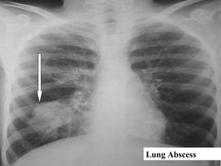 Lung Abscess
 