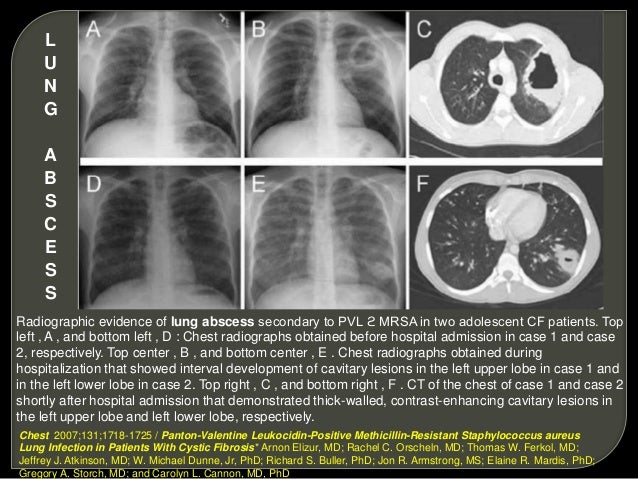 Respiratory pathology