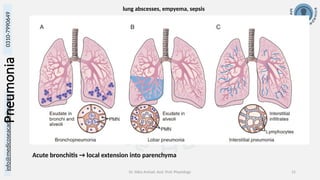 info@medicoseacademics.com
0310-7990649
Dr. Sidra Arshad, Asst. Prof. Physiology 15
Pneumonia
Acute bronchitis → local extension into parenchyma
lung abscesses, empyema, sepsis
 