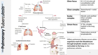 info@medicoseacademics.com
0310-7990649
Dr. Sidra Arshad, Asst. Prof. Physiology 21
Pulmonary
Tuberculosis
Ghon focus A 1-1.5 cm area od
consolidation with
caseous necrosis
Ghon complex Parenchymal + nodal
lesion
Ranke
complex
Fibrotic and calcified
Ghon complex
noticed on
radiographs
Simon focus 2° TB, a friable
nodule in the lung
apices
Scrofula Tuberculous cervical
lymphadenitis
Miliary pulmonary disease occurs when
organisms reach the bloodstream
through lymphatic vessels and then
recirculate to the lung via the
pulmonary arteries
 