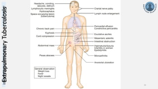info@medicoseacademics.com
0310-7990649
Dr. Sidra Arshad, Asst. Prof. Physiology 24
Extrapulmonary
Tuberculosis
 