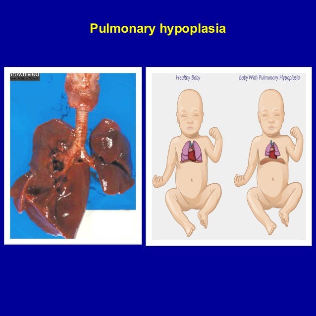 Respiratory problems in neonate