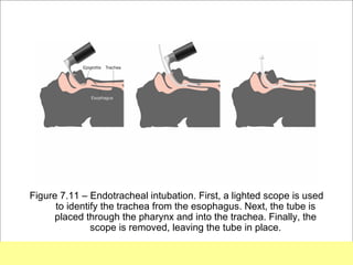 Figure 7.11 – Endotracheal intubation. First, a lighted scope is used
      to identify the trachea from the esophagus. Next, the tube is
      placed through the pharynx and into the trachea. Finally, the
               scope is removed, leaving the tube in place.
                                                         Copyright ©2009 by Pearson Education, Inc.
Medical Terminology: A Living Language, Fourth Edition       Upper Saddle River, New Jersey 07458
Bonnie F. Fremgen and Suzanne S. Frucht                                          All rights reserved.
 